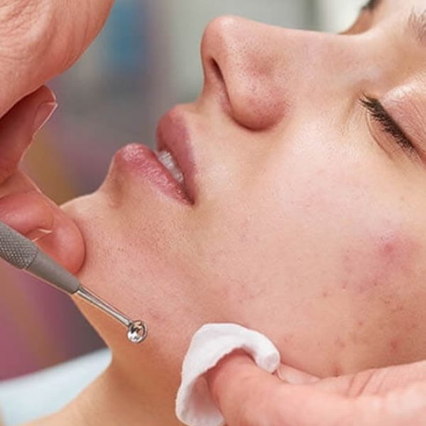 tratamient_acne
